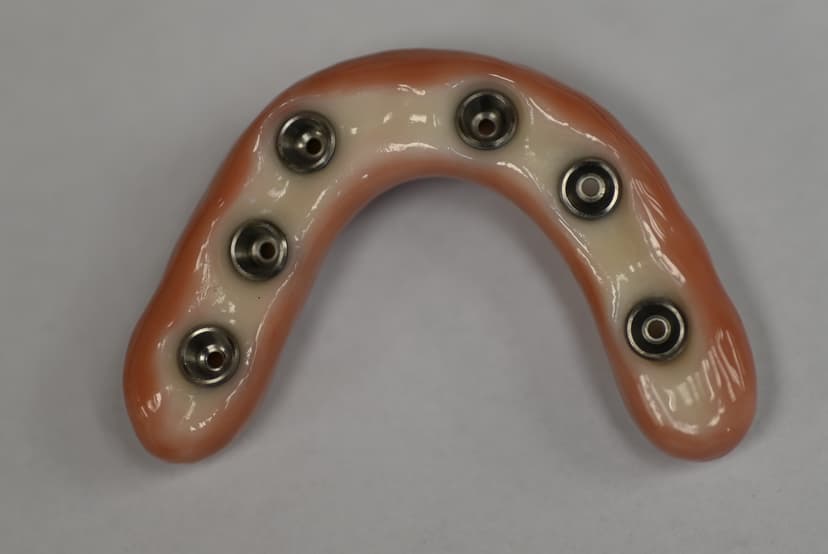 Implant Denture 2